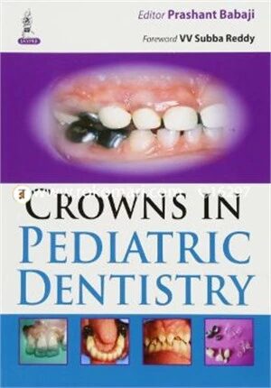 Crowns in Pediatric Dentistry